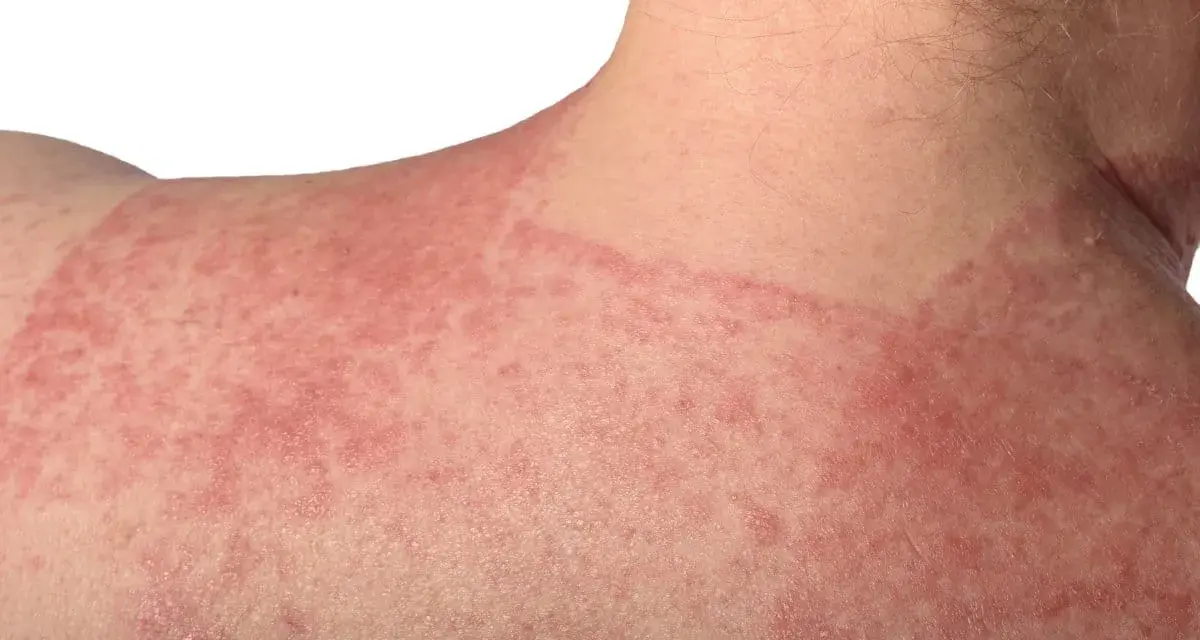 Estesa infiammazione della pelle con arrossamento e piccole pustole sul collo e sulla spalla.