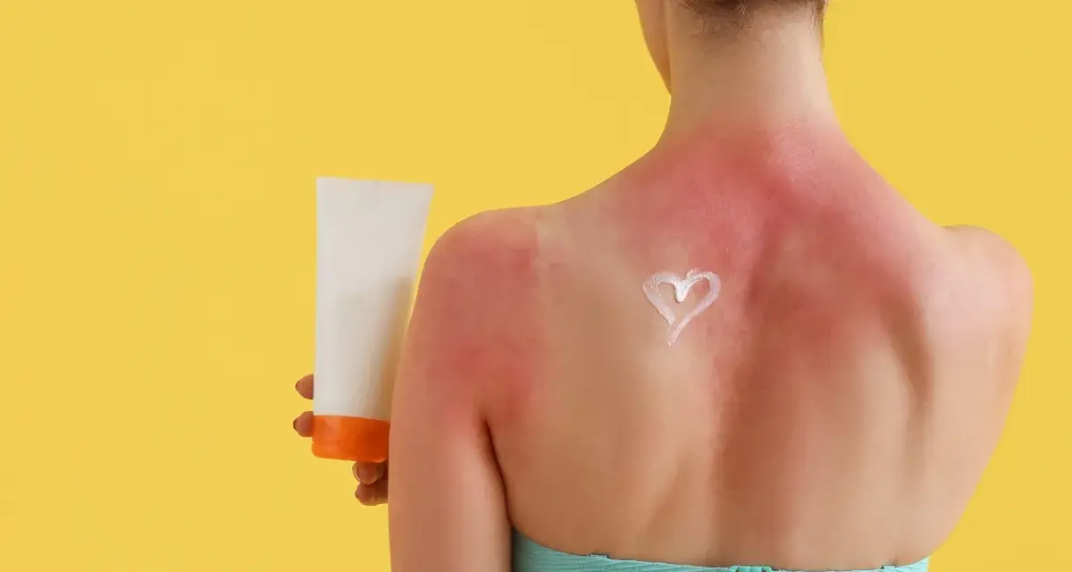 Schiena arrossata e dolente per una scottatura solare. Una crema solare a forma di cuore promette sollievo.