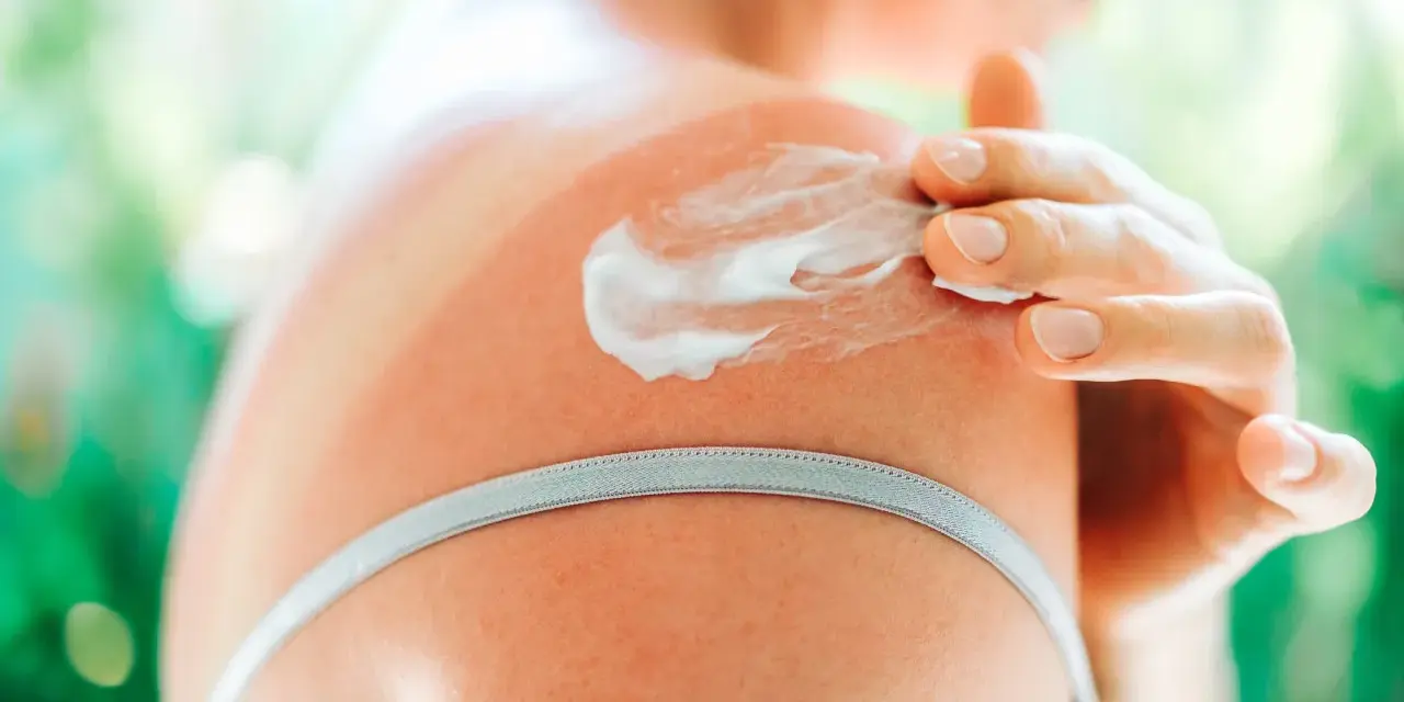 Spalla arrossata dal sole, una mano applica crema solare come crema idratante per lenire la pelle.