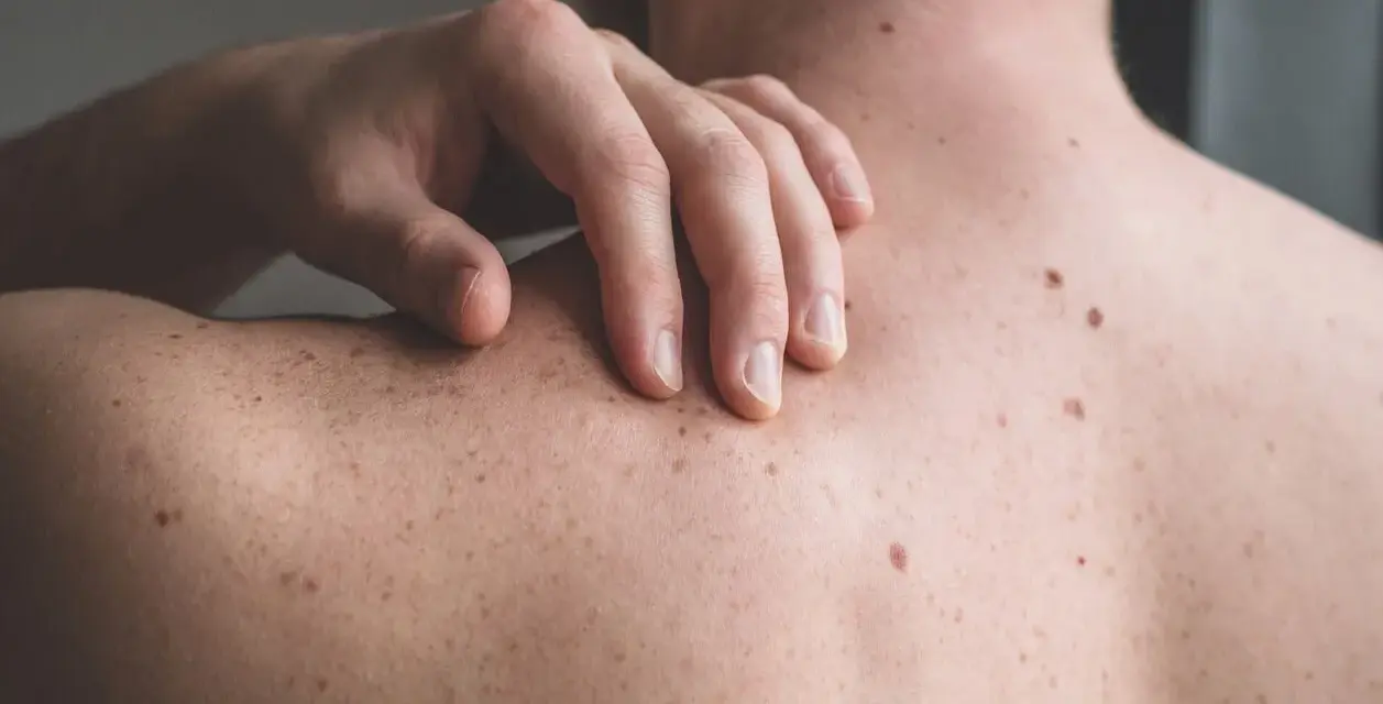 Mano che si gratta la schiena, coperta di nei. Un piccolo brufolo spunta su uno dei nei, un dettaglio inaspettato sulla pelle.