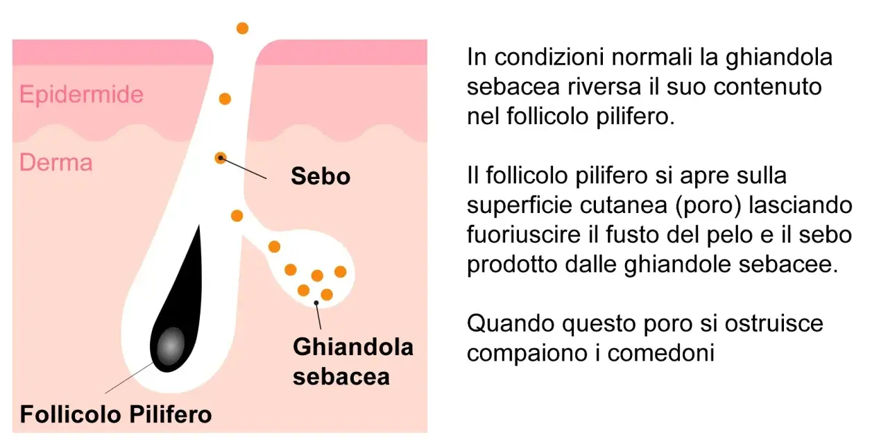 Illustrazione anatomica della pelle che spiega cosa sono i punti neri: il sebo ostruisce il follicolo pilifero.