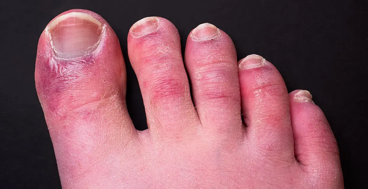 Dita dei piedi arrossate e gonfie, con segni di **geloni ai piedi**. La pelle appare secca e screpolata, soprattutto attorno alle unghie.