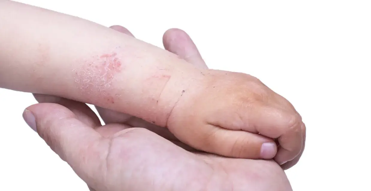 Braccio di bambino con chiazze rosse e squamose, sintomo di dermatite acuta, tenuto da una mano adulta.