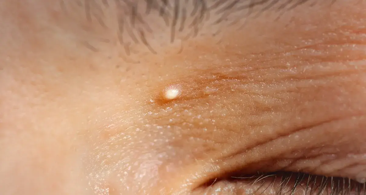 Un piccolo brufolo, simile a grani di miglio, appare sulla pelle rugosa vicino all'occhio.