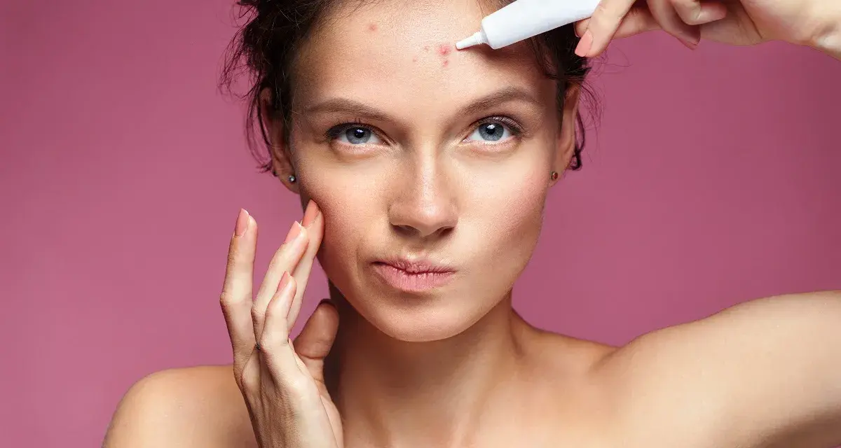 Donna applica crema su un brufolo sulla fronte, preoccupata di quanto dura un brufolo.
