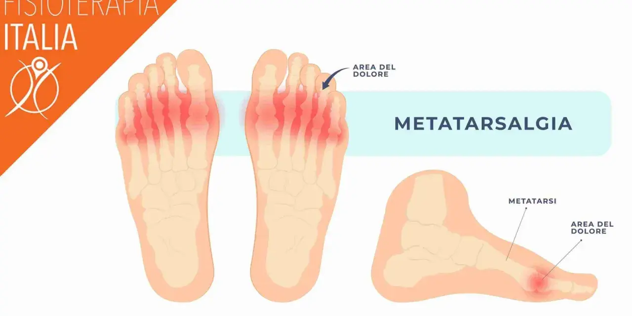 Illustrazione anatomica del piede che mostra la metatarsalgia, un dolore sotto le dita. Rimedi naturali per il dolore sotto le dita del piede.