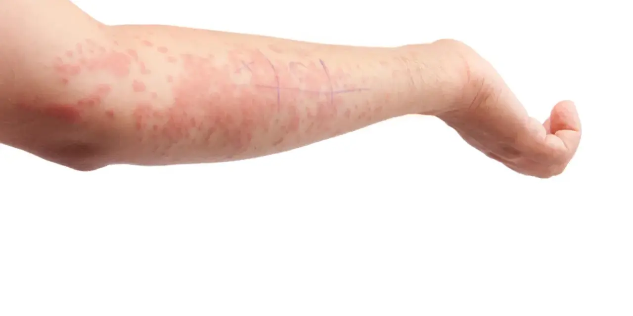 Braccio con eruzione cutanea rossa e pruriginosa, tipica dell'orticaria. Scopri come curarla.