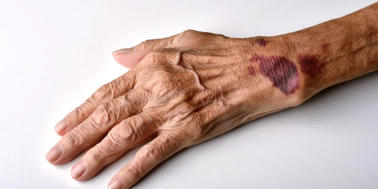 Mano anziana con evidenti segni di atrofia cutanea e lividi sul dorso, pelle sottile e rugosa.