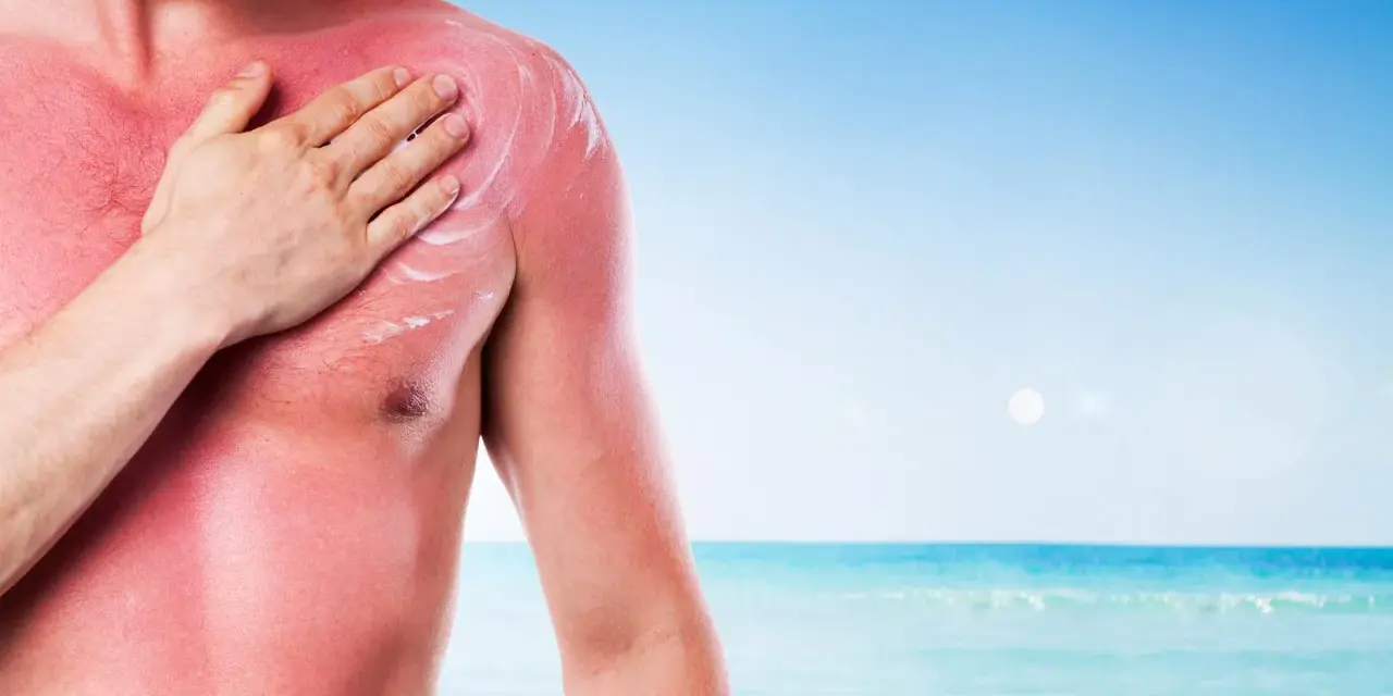 Uomo con forte eritema solare sul petto e spalla, mentre si applica una crema lenitiva. Il mare sullo sfondo ricorda l'estate.