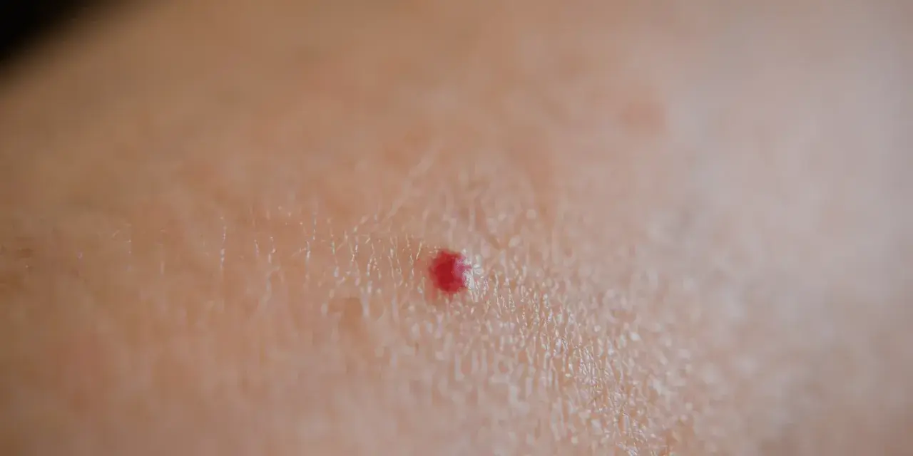 Piccola macchia rossa sulla pelle, tipo bruciatura, che prude.
