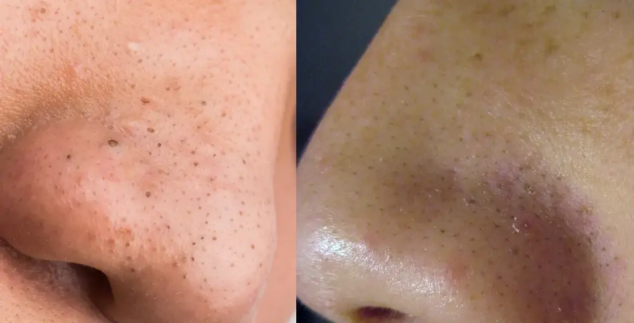 Confronto tra punti neri e filamenti sebacei sul naso. I filamenti sebacei appaiono come piccoli puntini chiari, mentre i punti neri sono più scuri e visibili.