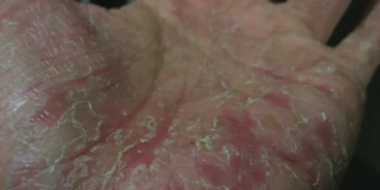 Mano con pelle secca, screpolata e arrossata, sintomo di disidrosi mani.