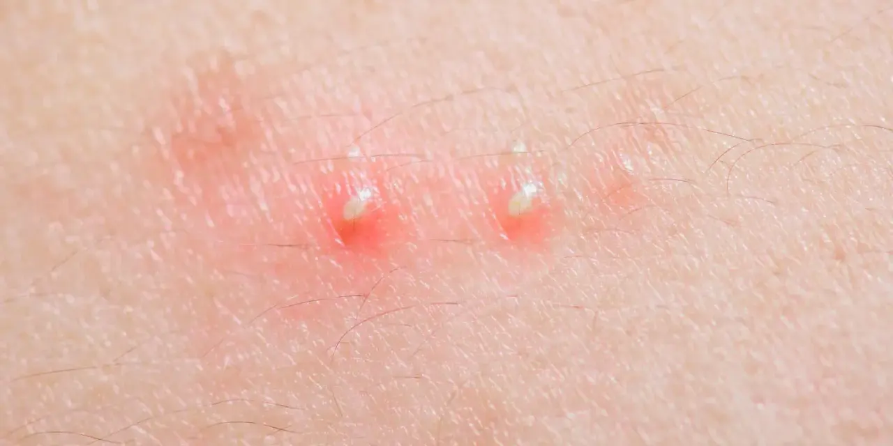 Due pustole sul corpo, rosse e gonfie, con la punta bianca, circondate da peluria sottile.