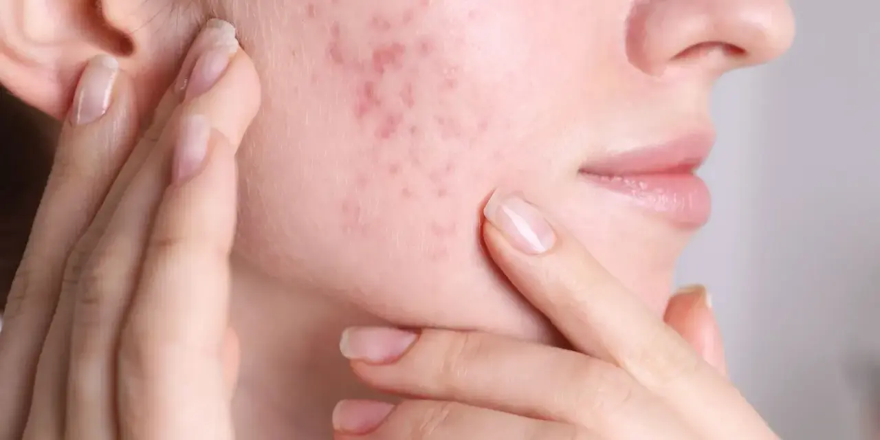 Primo piano del viso di una donna con brufoli sul viso, che si tocca la guancia. Capire perchè vengono i brufoli è il primo passo per una pelle sana.