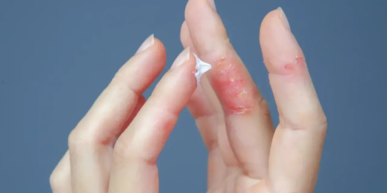 Mani con dermatite dita: pelle arrossata, screpolata e con piccole lesioni. Una mano applica crema.
