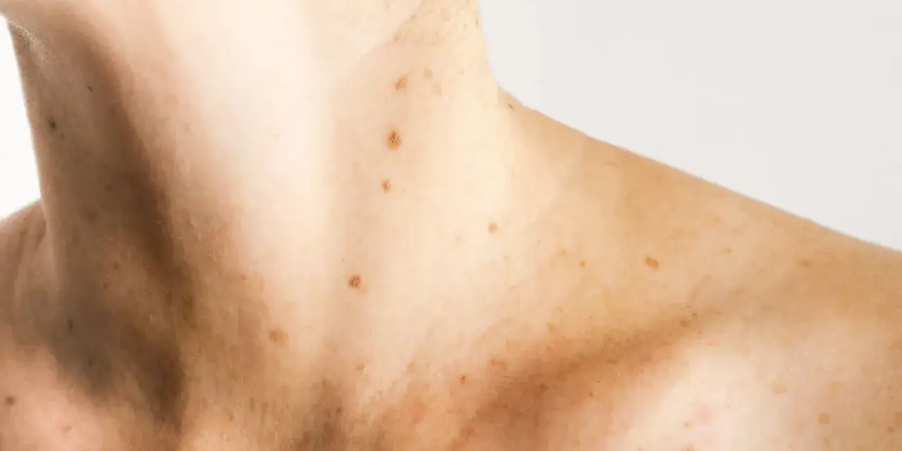 Pelle chiara con numerose macchie solari e lentiggini sul collo e sulle spalle. Alcune macchie solari vanno via da sole, altre rimangono.