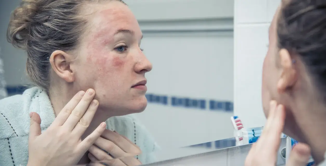 Donna con viso arrossato e irritato si guarda allo specchio, preoccupata che la glicerina viso fa male.