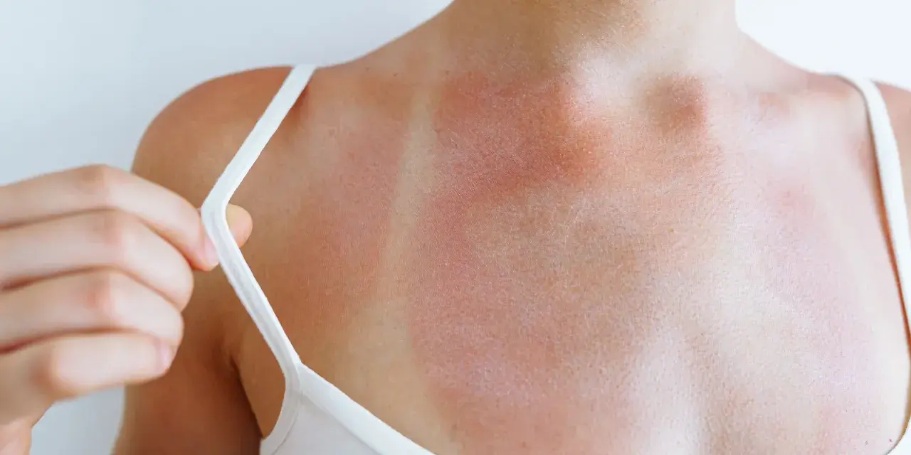 Spalla arrossata e irritata, con segni evidenti di eritema solare prurito. La pelle è segnata dal sole.