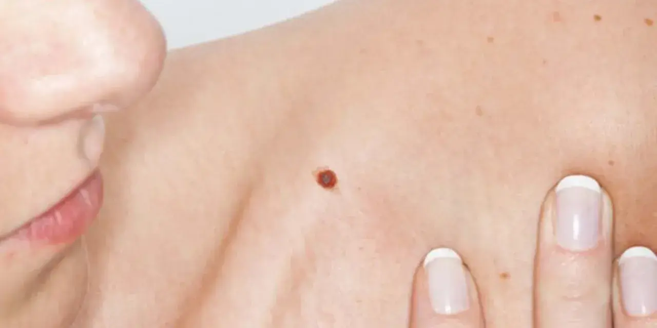 Primo piano di una spalla con un neo rosso sulla pelle. Dita con unghie curate sfiorano delicatamente la cute.