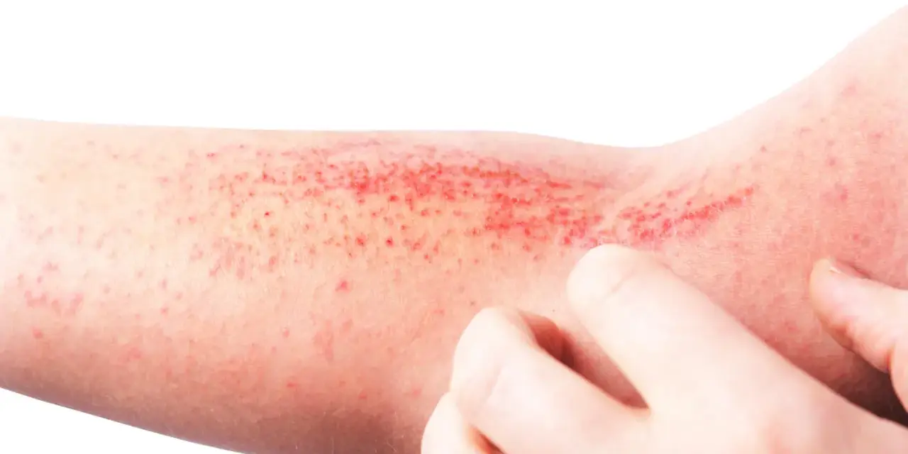 Braccio con eruzione cutanea rossa e puntini, possibile micosi dermatite da stress senza prurito.