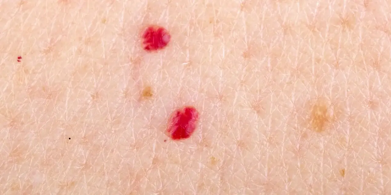 Primo piano della pelle con due angiomi rubino. Si cercano angioma rubino rimedi naturali per attenuare queste piccole macchie rosse.
