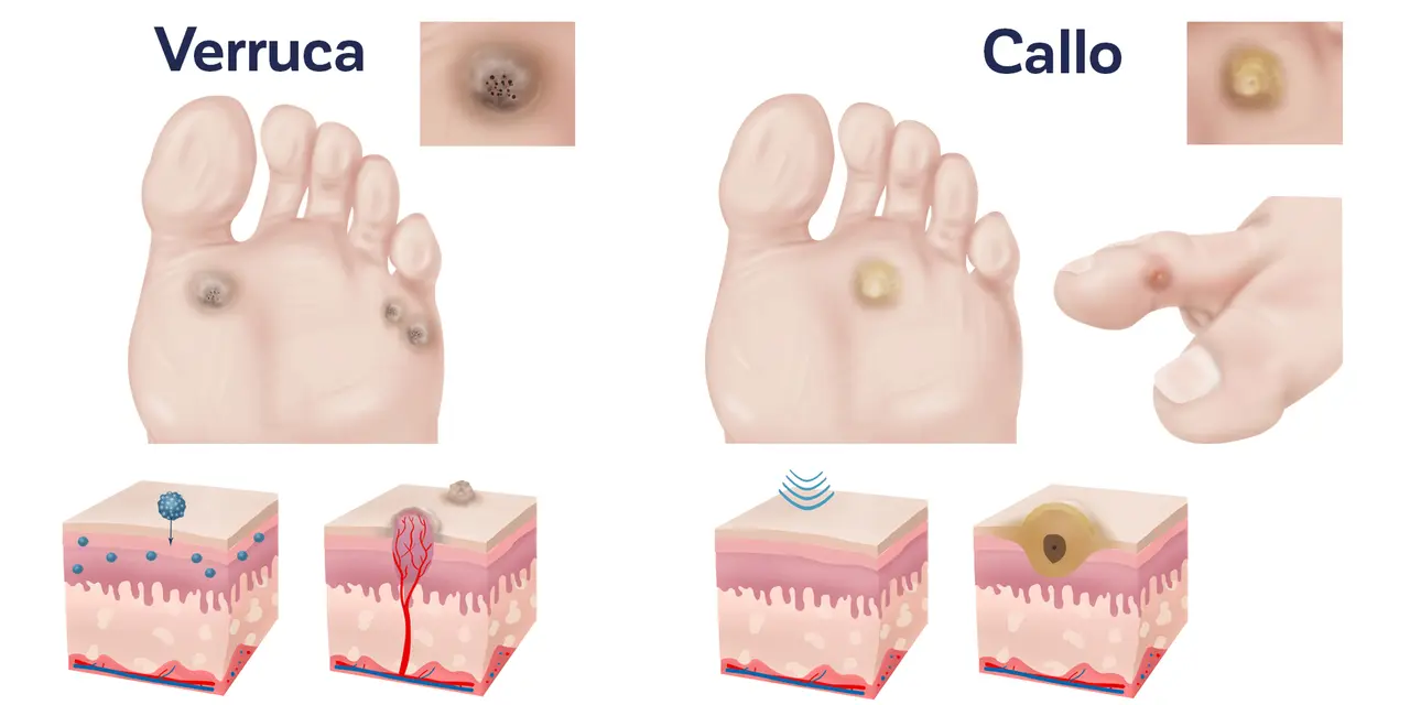 Illustrazione comparativa di verruche e calli, mostrando i diversi tipi e le loro caratteristiche cutanee.