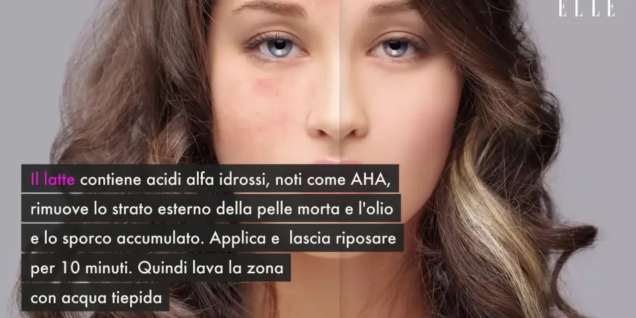 Scopri come togliere i brufoli dal viso con il latte, ricco di AHA che esfoliano e puliscono la pelle.