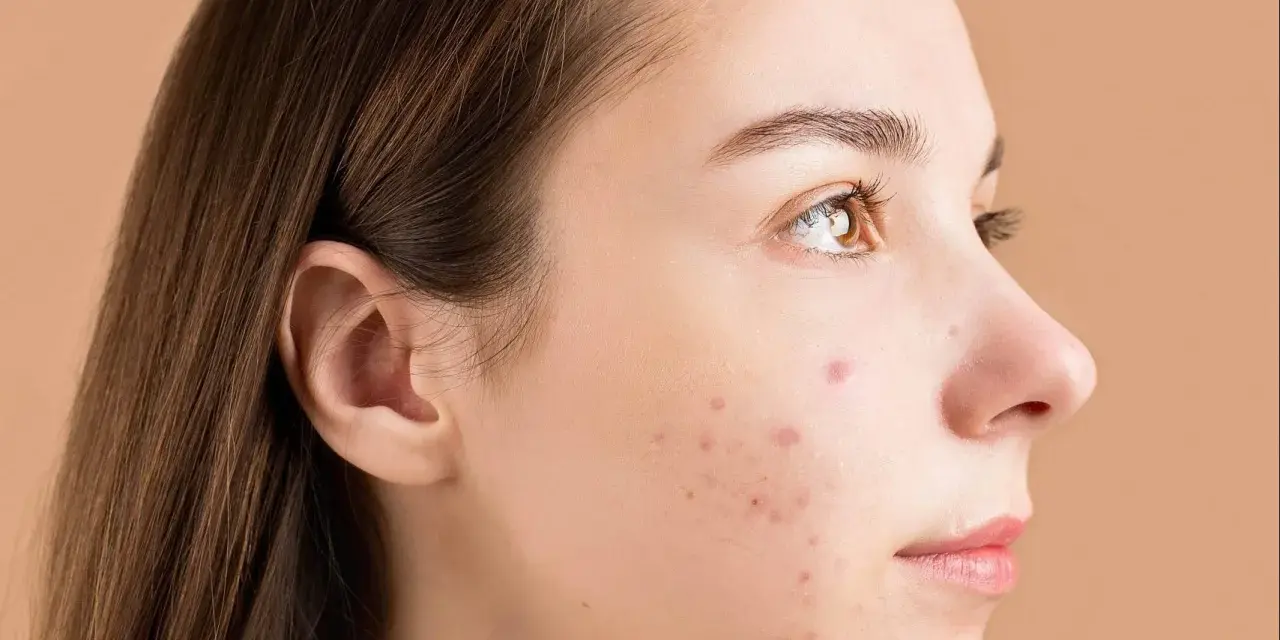 Primo piano del viso di una giovane donna con brufoli. La domanda "quanto ci mette un brufolo ad andare via" è centrale per chi soffre di acne.