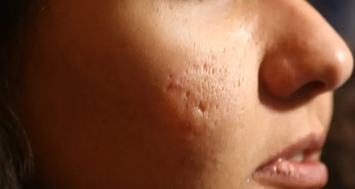 Primo piano del viso di una persona con evidenti cicatrici da acne, simili a macchie varicella, sulla guancia.