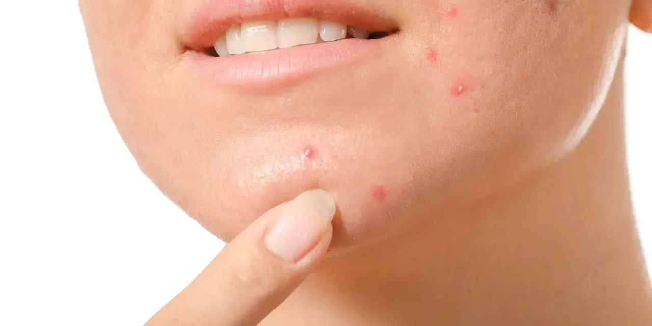 Dito, come non schiacciare i brufoli: un dito indica un brufolo sul viso, vicino alla bocca.