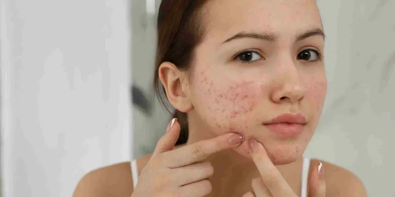 Viso di giovane donna con rossori e brufoli, un segno comune di acne in gravidanza.