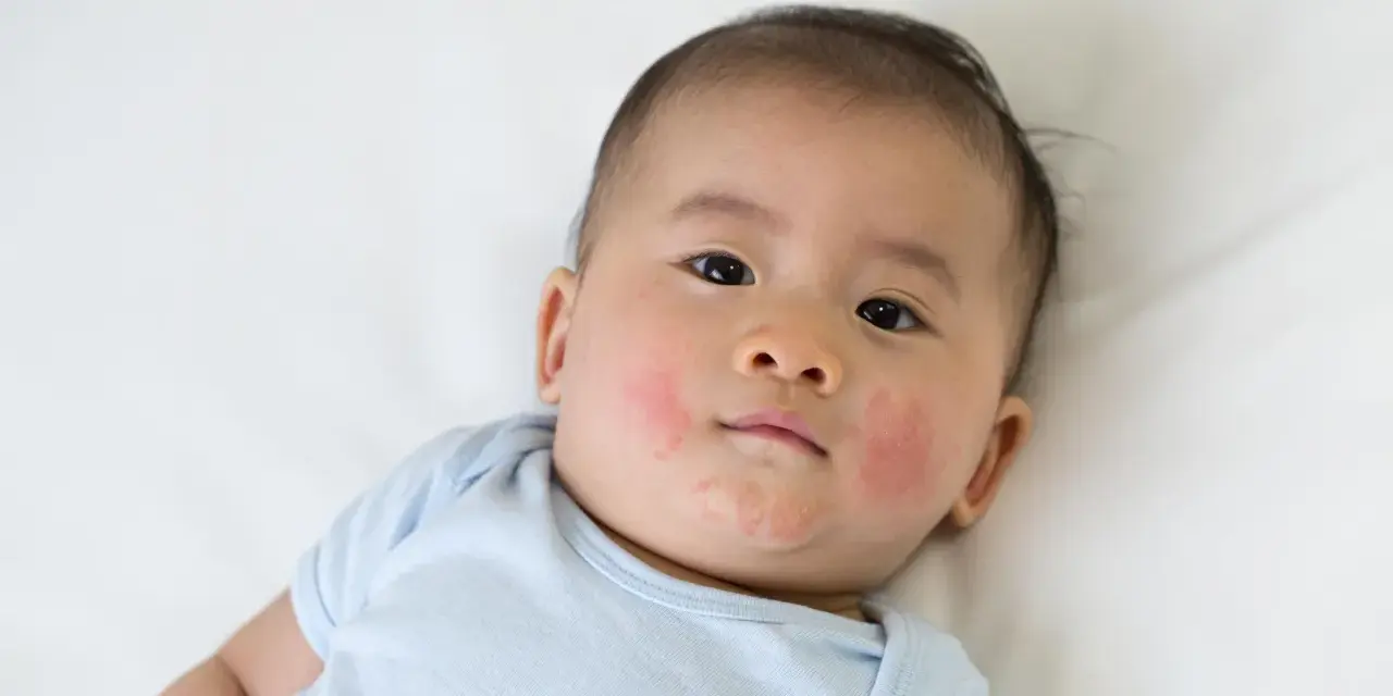 Bambino con guance arrossate e screpolate, forse per la differenza tra dermatite atopica e seborroica.