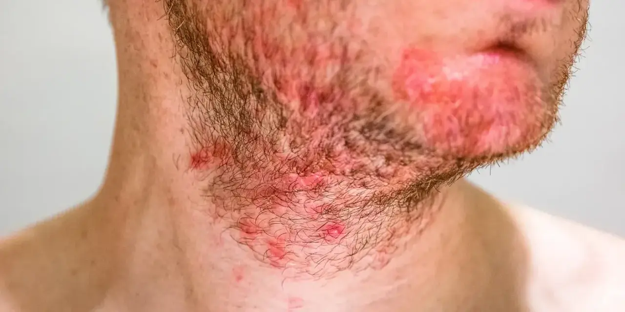 Primo piano del collo di un uomo con irritazione e brufoli sul collo, rossore e peli della barba.