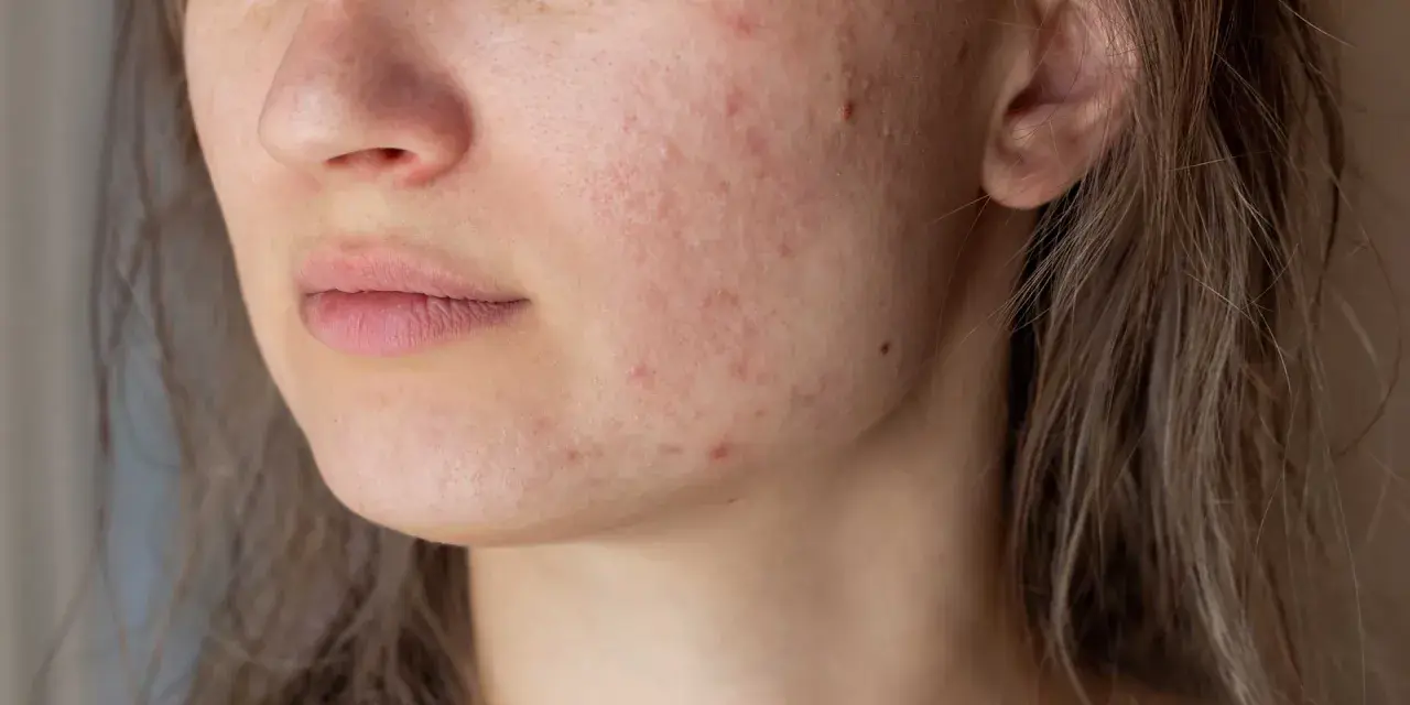 Primo piano del viso di una giovane donna con pelle arrossata e imperfezioni, tipiche dell'acne aestivalis.
