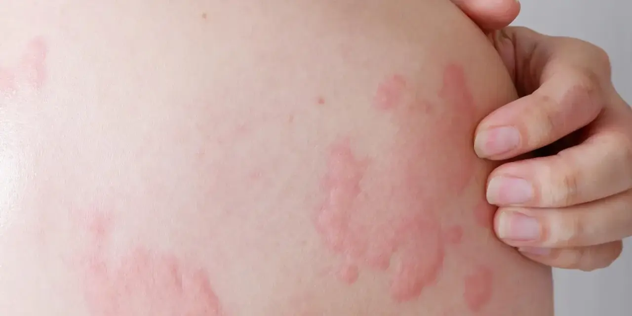 Pelle con pomfi rossi e pruriginosi, sintomo di orticaria solare. Una mano sfiora la zona colpita.