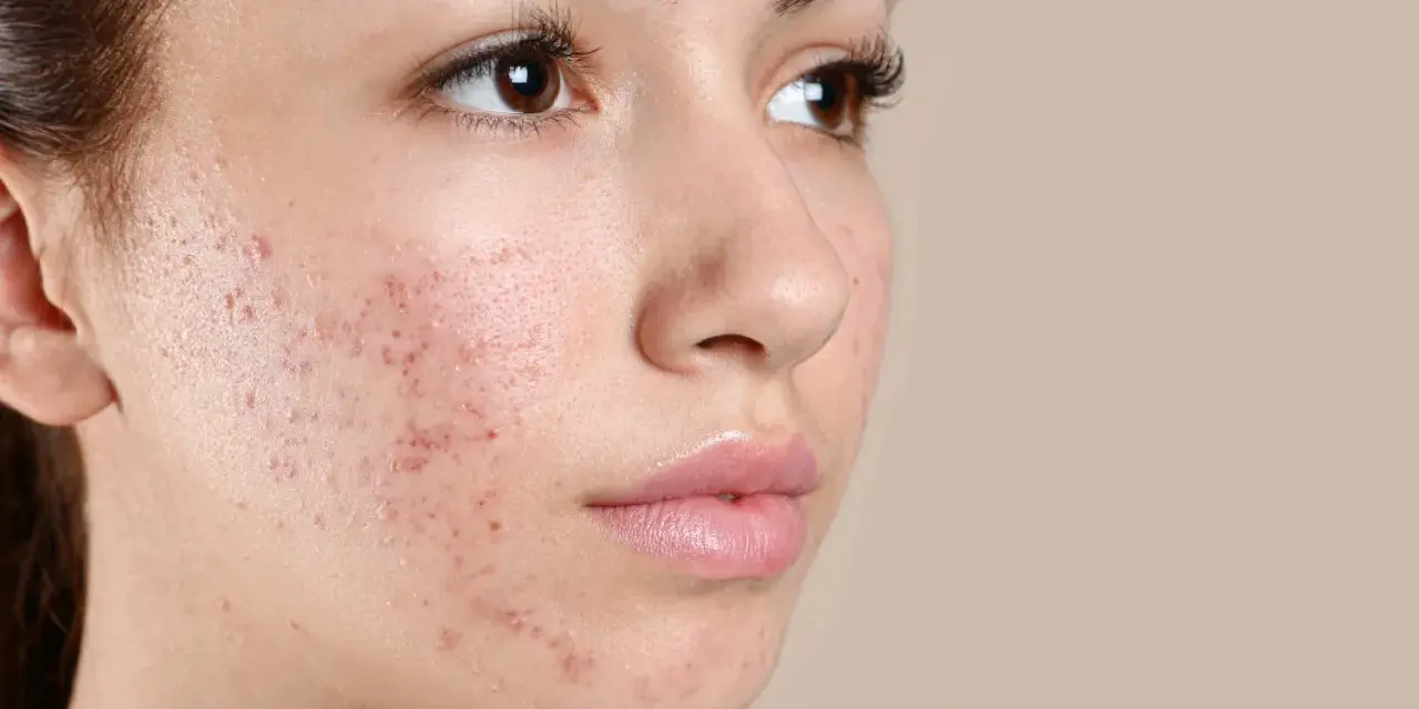 Primo piano del viso di una giovane donna con evidenti bollicine sul viso, segno di acne.