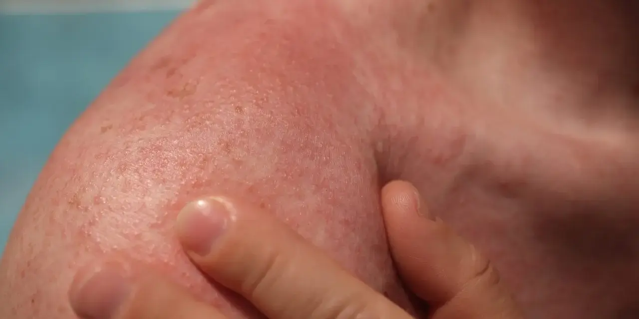 Spalla arrossata e irritata, con piccoli puntini rossi. Potrebbe essere necessario cercare rimedi eritema solare.
