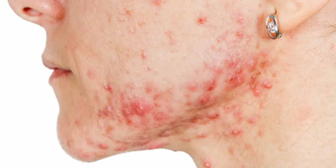Primo piano del viso di una persona con acne, con un brufolo che non va via e arrossamenti evidenti.