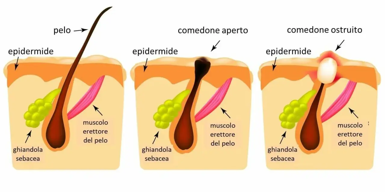 Illustrazione che spiega perchè escono i brufoli: un poro ostruito da sebo e cellule morte causa infiammazione.