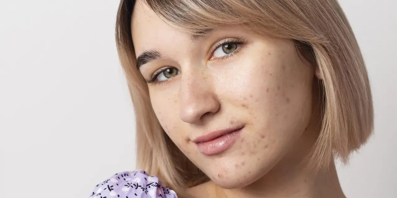 Primo piano di una giovane donna con pelle chiara e capelli biondi, che mostra segni di acne da sudore sul viso.