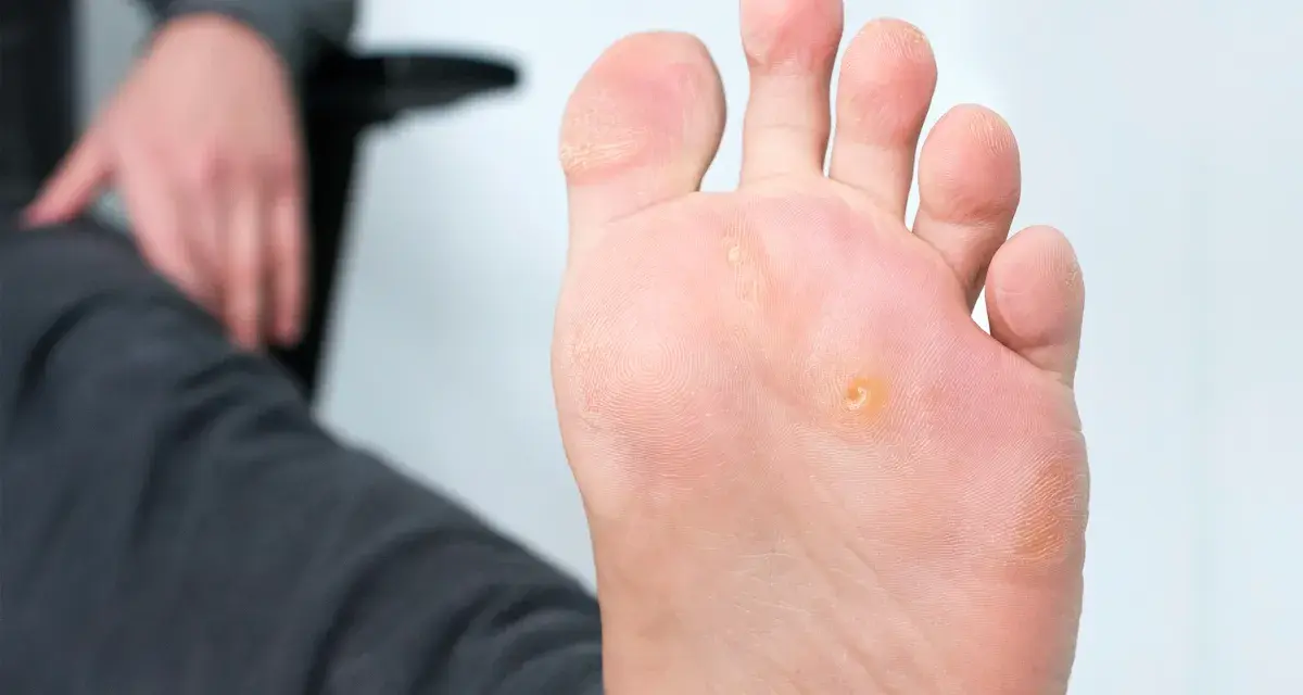Primo piano di un piede con un occhio di pernice. Scopri come toglierlo facilmente.