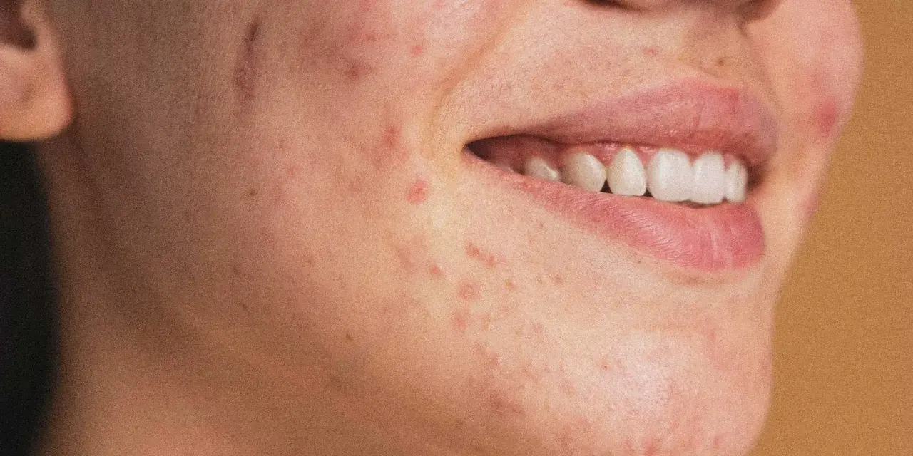 Primo piano del viso di una persona con vari tipi di brufoli e imperfezioni sulla pelle.