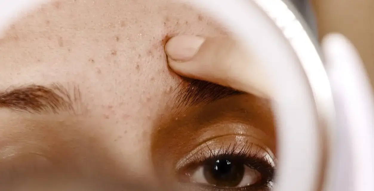 Dito un dito preme sulla fronte, evidenziando un piccolo buco nella pelle dopo brufolo, tra altre imperfezioni.