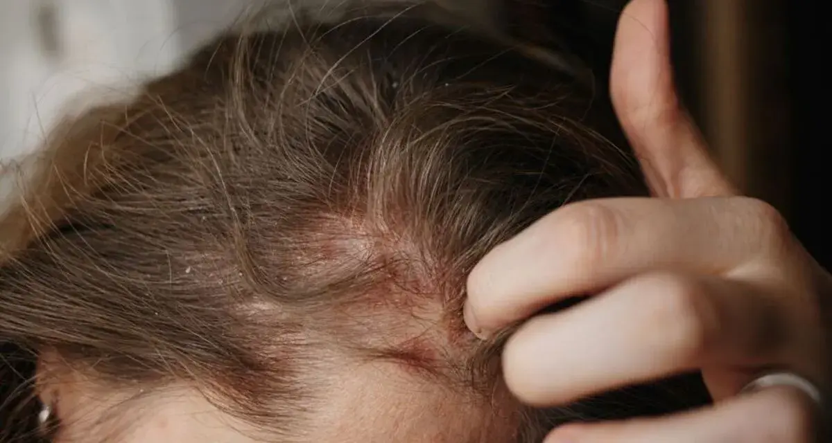 Dita che grattano un cuoio capelluto arrossato e dolorante, con evidenti squame bianche tra i capelli castani.