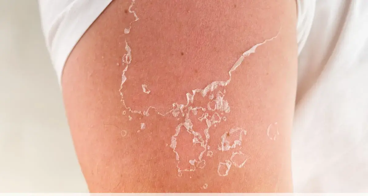 Pelle che si desquama dopo un'esposizione solare. Scopri come togliere la pelle morta dal corpo in modo delicato.