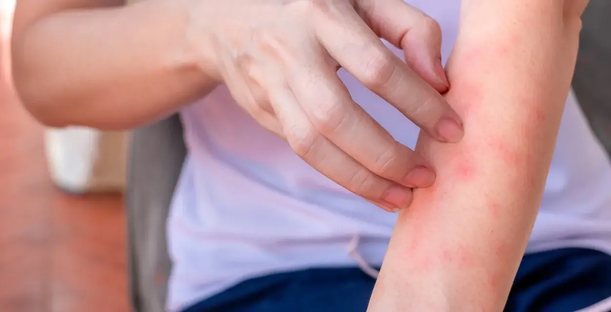 Mano che si gratta un braccio arrossato, con piccoli sfoghi che ricordano l'eczema sulle gambe.