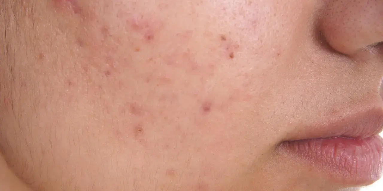 Primo piano di una guancia con diversi brufoli e pori dilatati, che evidenziano la texture della pelle.
