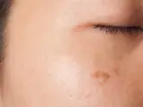 Primo piano del viso con imperfezioni e macchie che evidenziano la pigmentazione pelle.