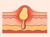 Sezione trasversale della pelle che mostra un brufolo viola infiammato con pus giallo.