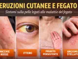 Eruzioni cutanee e ittero, sintomi legati al fegato. Macchie rosse, prurito persistente e angiomi stellati possono indicare problemi epatici.